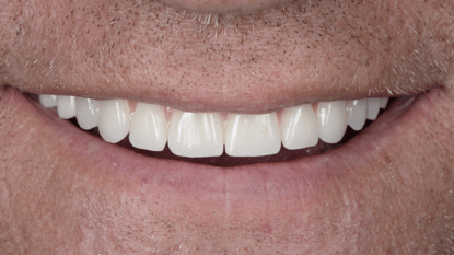 Should I whiten my teeth before an implant?