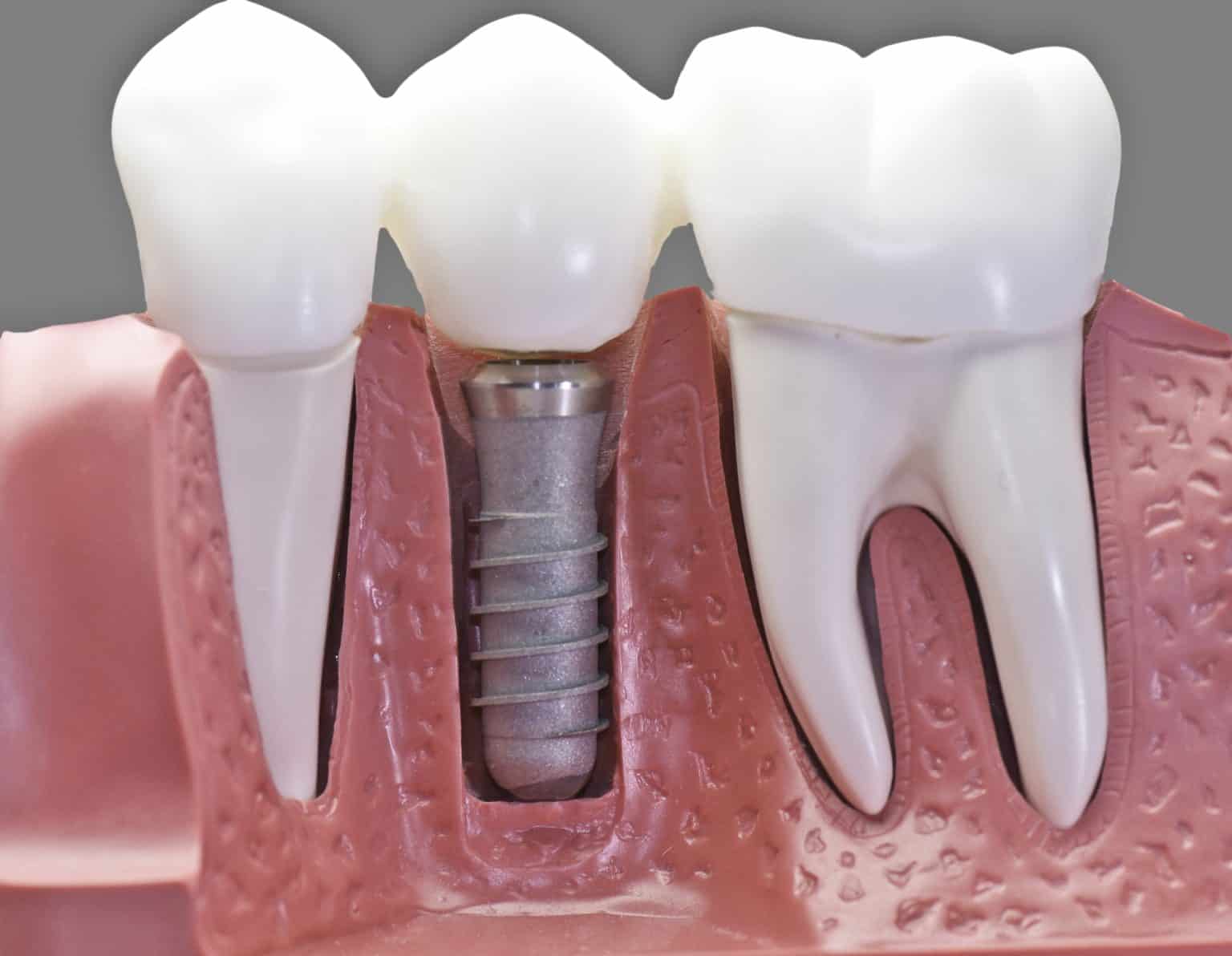 Is there a cheaper alternative to dental implants? AccessibleInfo